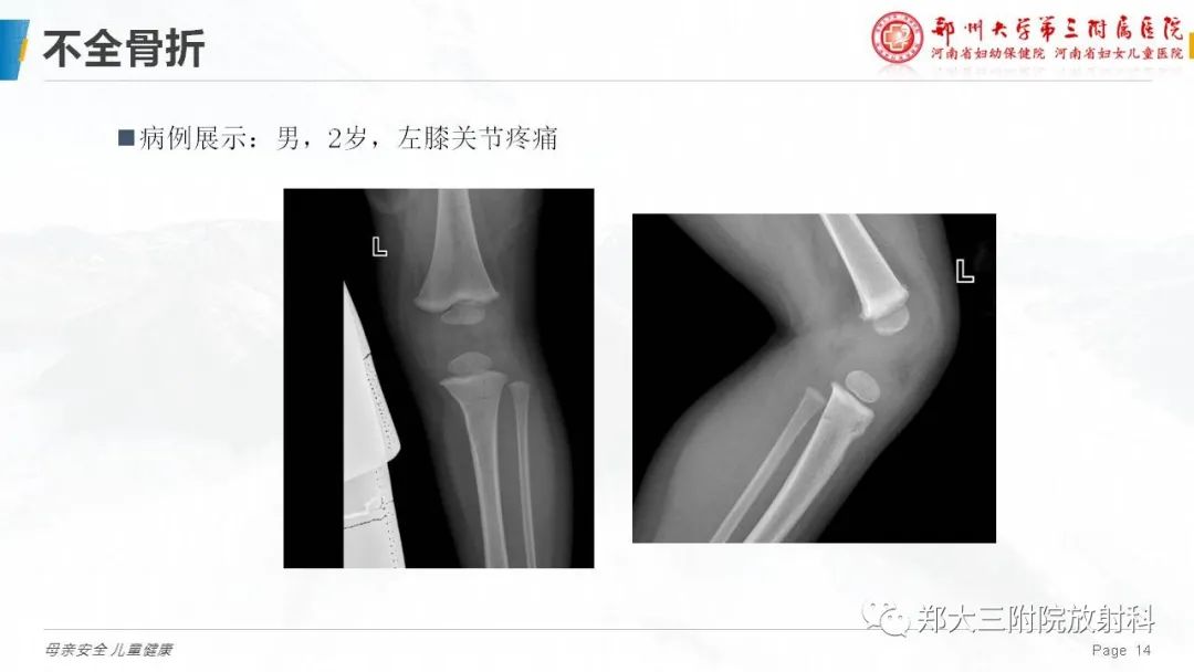 影像PPT - 【PPT】儿童骨折的影像诊断分析-14