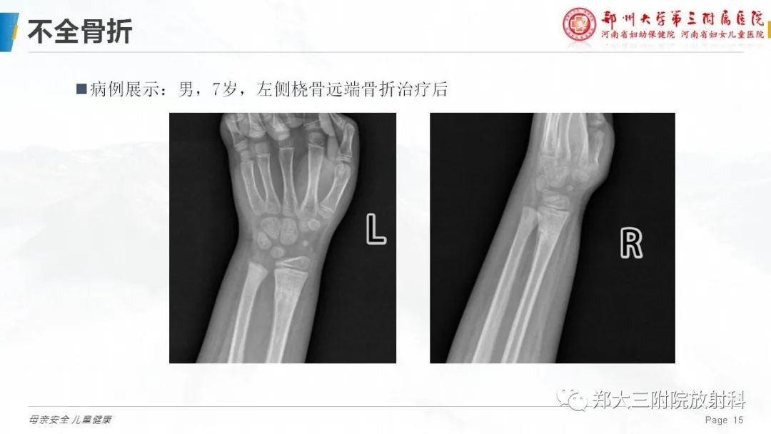 影像PPT - 【PPT】儿童骨折的影像诊断分析-15