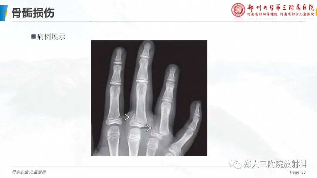影像PPT - 【PPT】儿童骨折的影像诊断分析-20