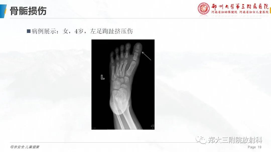 影像PPT - 【PPT】儿童骨折的影像诊断分析-19