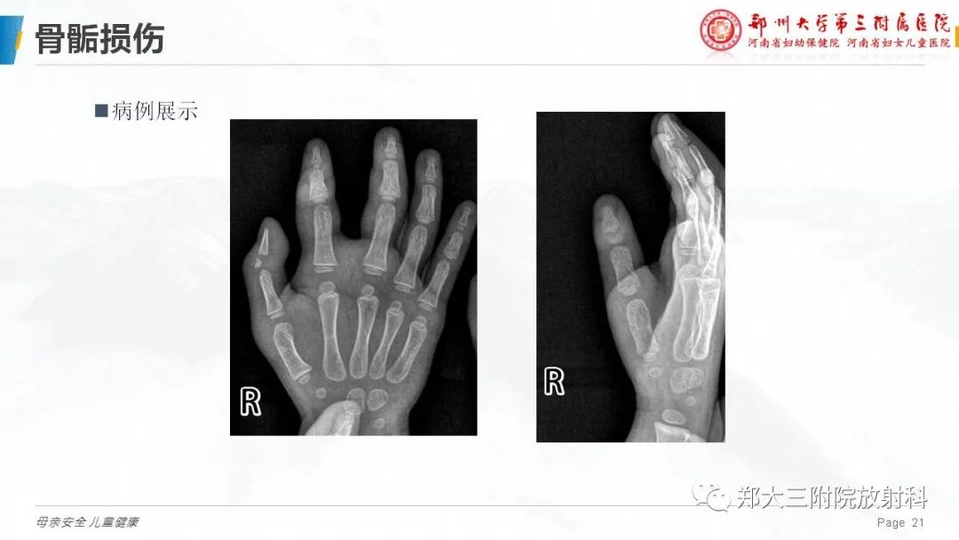 影像PPT - 【PPT】儿童骨折的影像诊断分析-21