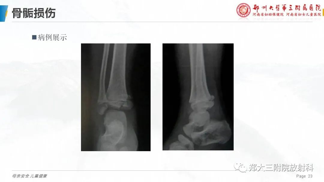 影像PPT - 【PPT】儿童骨折的影像诊断分析-23
