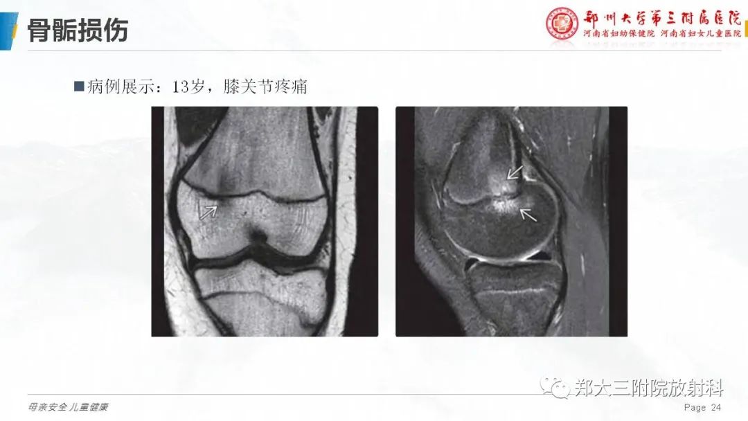 影像PPT - 【PPT】儿童骨折的影像诊断分析-24