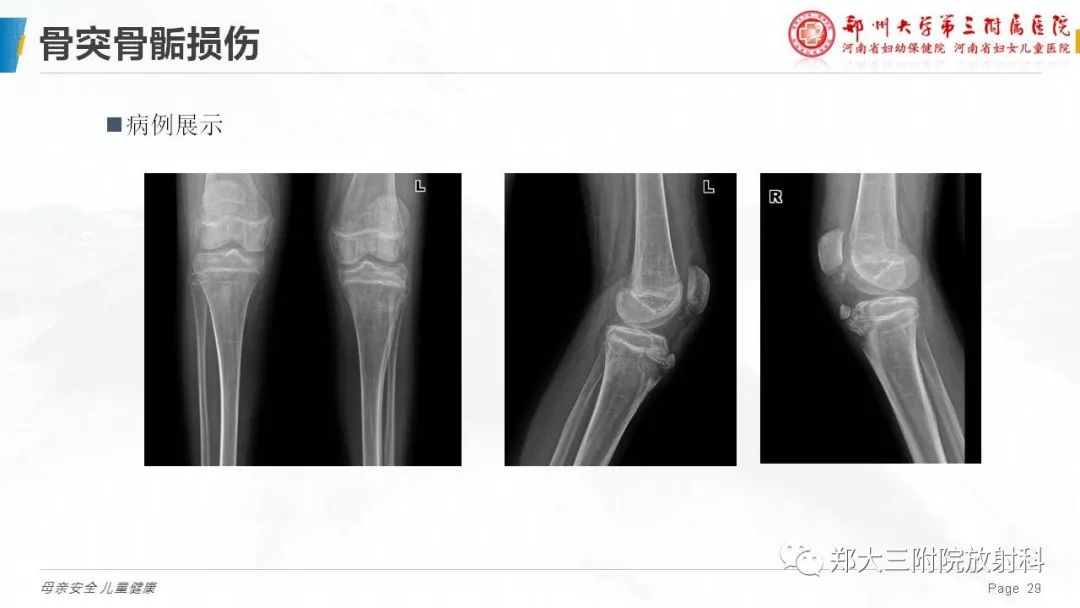 影像PPT - 【PPT】儿童骨折的影像诊断分析-29