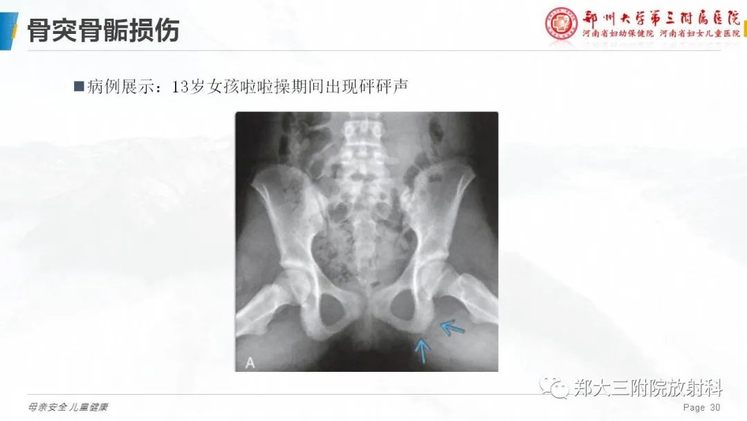 影像PPT - 【PPT】儿童骨折的影像诊断分析-30