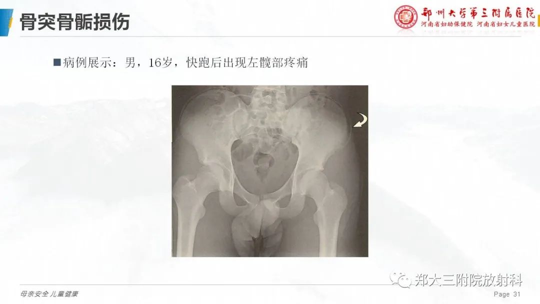 影像PPT - 【PPT】儿童骨折的影像诊断分析-31