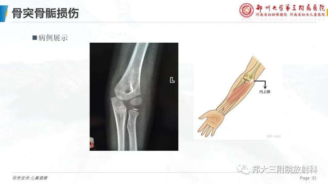 影像PPT - 【PPT】儿童骨折的影像诊断分析-32