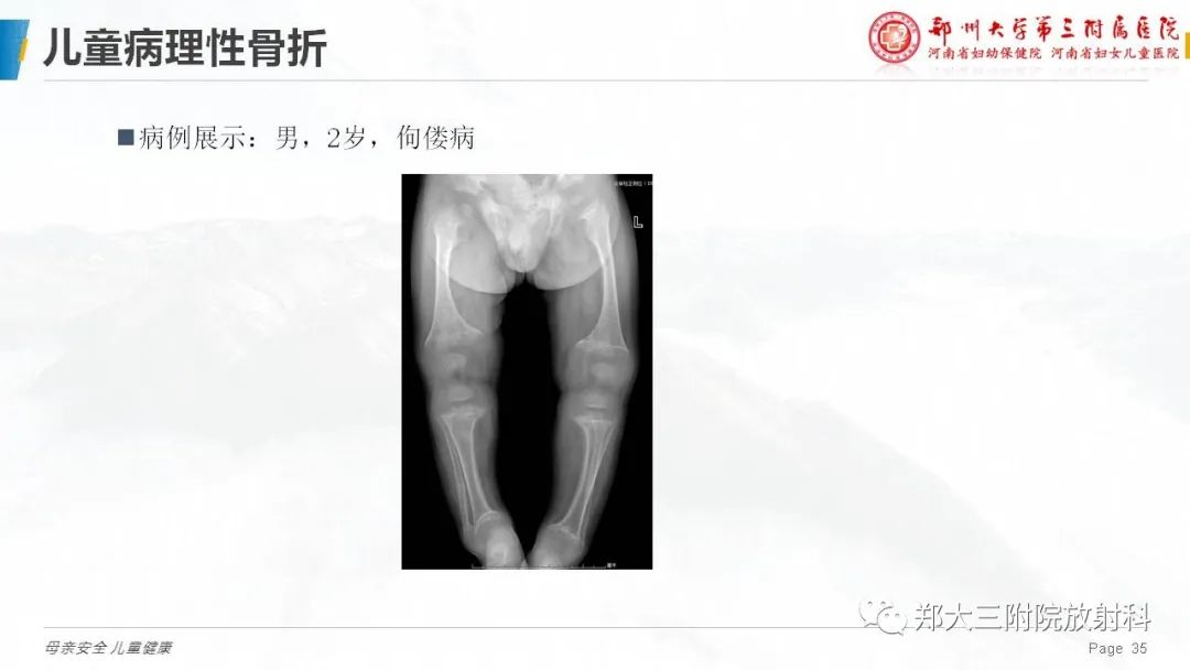 影像PPT - 【PPT】儿童骨折的影像诊断分析-35