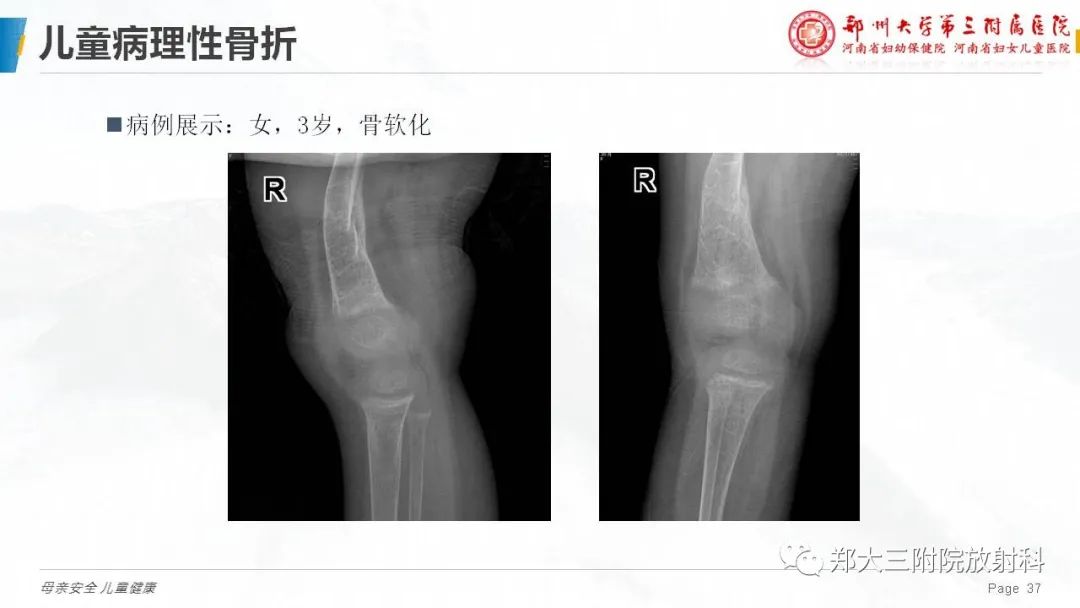 影像PPT - 【PPT】儿童骨折的影像诊断分析-37