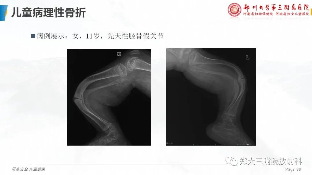 影像PPT - 【PPT】儿童骨折的影像诊断分析-36