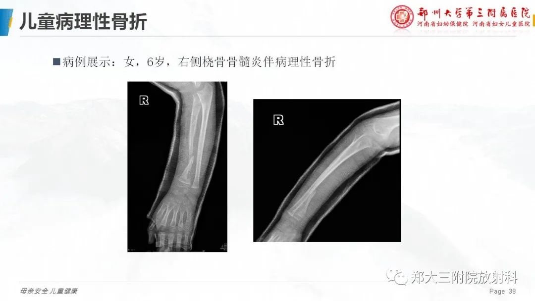 影像PPT - 【PPT】儿童骨折的影像诊断分析-38