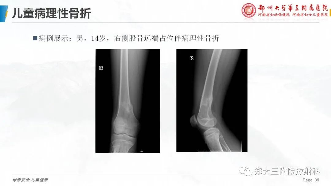 影像PPT - 【PPT】儿童骨折的影像诊断分析-39