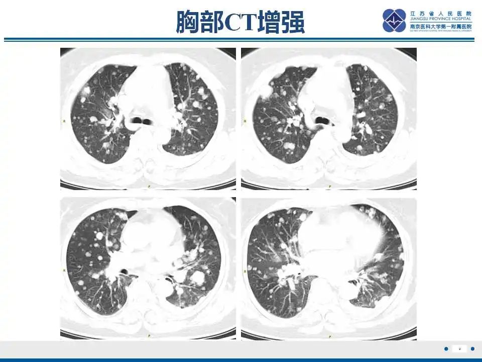 影像PPT - 【PPT】转移性黑色素瘤-3