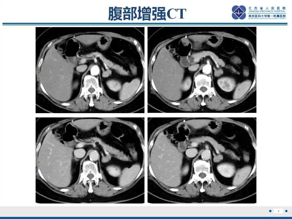 影像PPT - 【PPT】转移性黑色素瘤-5