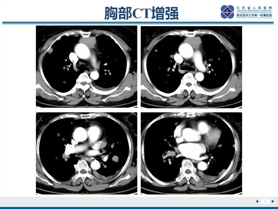 影像PPT - 【PPT】转移性黑色素瘤-4
