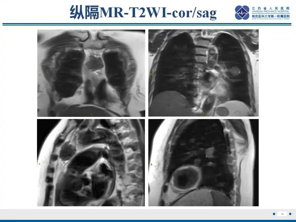 影像PPT - 【PPT】转移性黑色素瘤-15