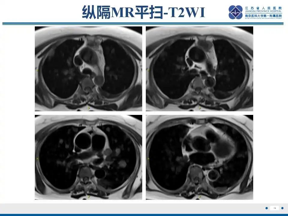 影像PPT - 【PPT】转移性黑色素瘤-14