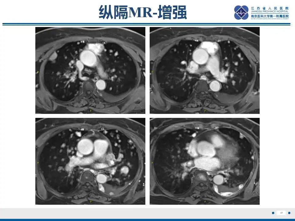 影像PPT - 【PPT】转移性黑色素瘤-18