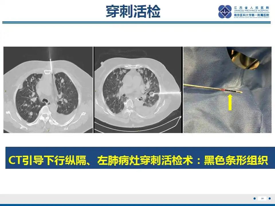 影像PPT - 【PPT】转移性黑色素瘤-26