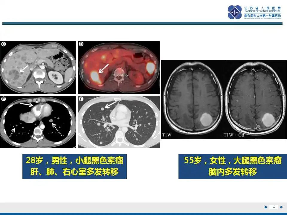 影像PPT - 【PPT】转移性黑色素瘤-41