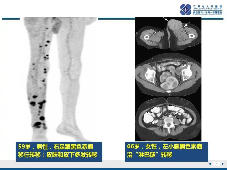 影像PPT - 【PPT】转移性黑色素瘤-40