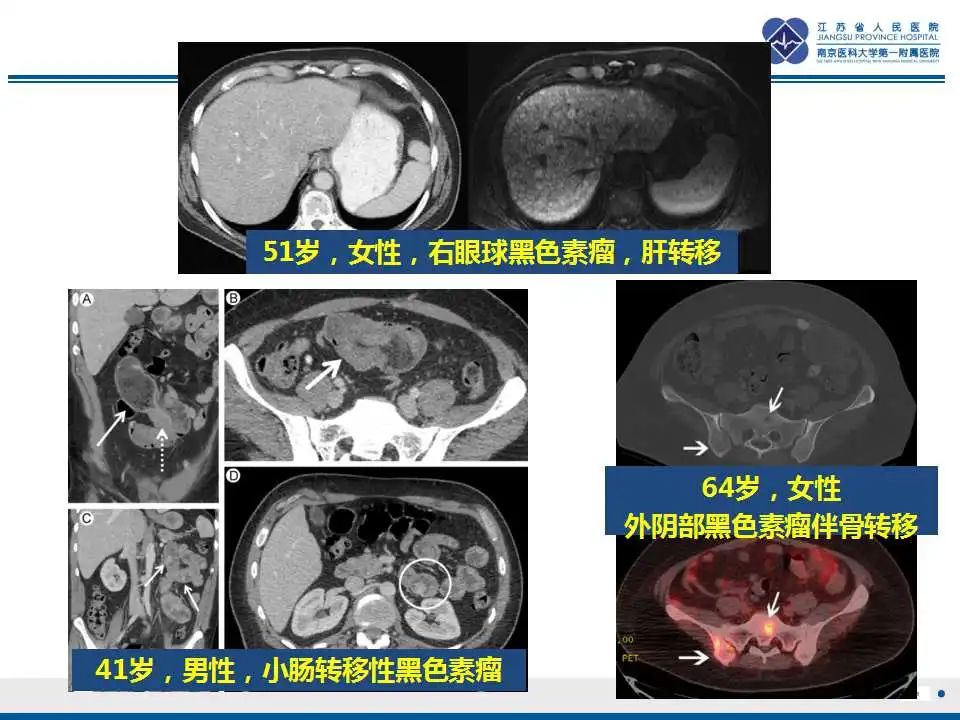 影像PPT - 【PPT】转移性黑色素瘤-42