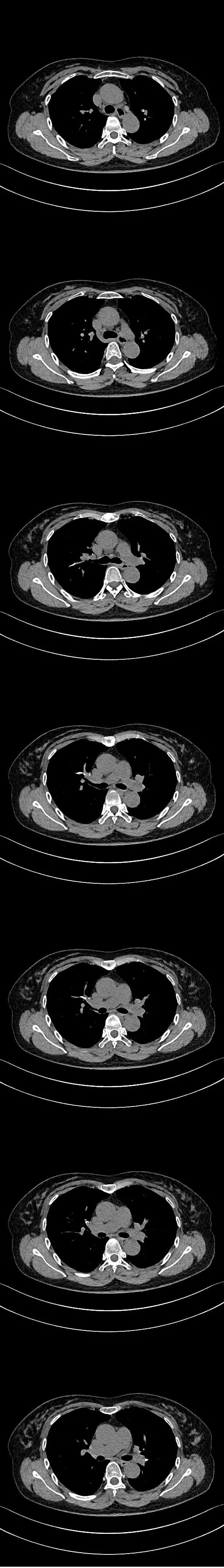影像PPT - 【病例】骨水泥肺栓塞1例CT-1