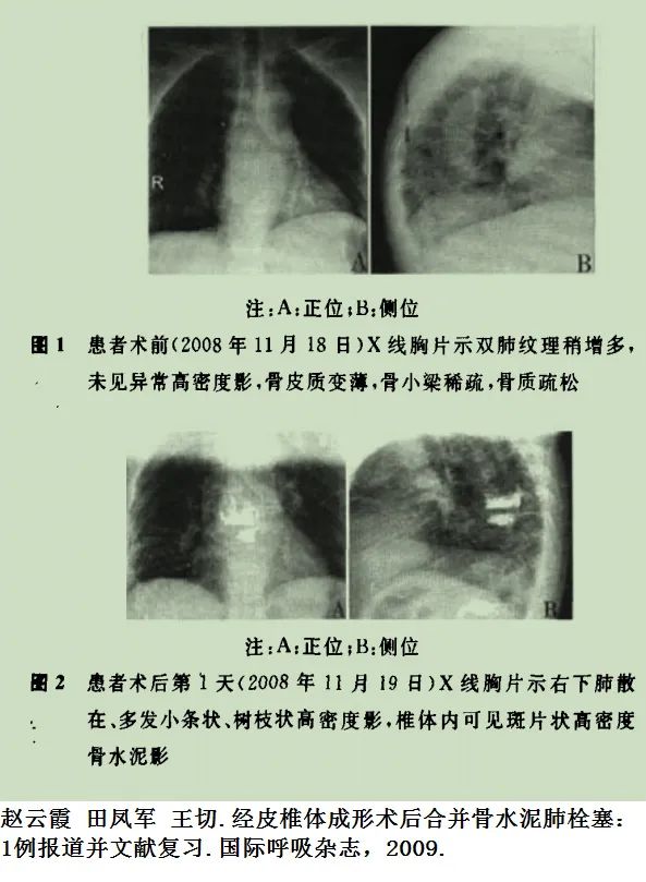 影像PPT - 【病例】骨水泥肺栓塞1例CT-4