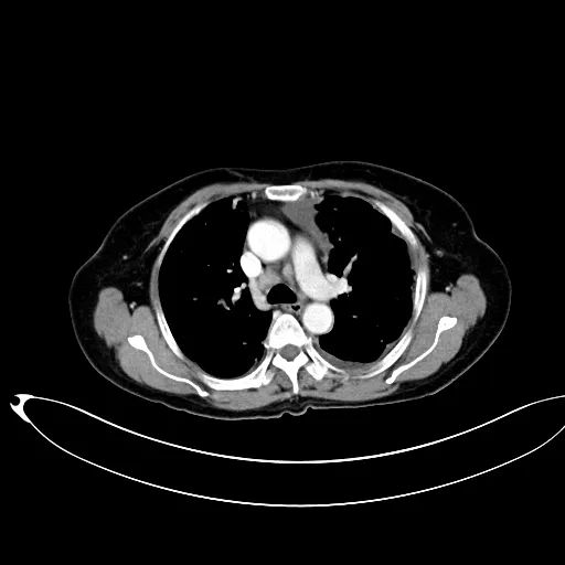影像PPT - 【病例】骨水泥肺栓塞1例CT-3