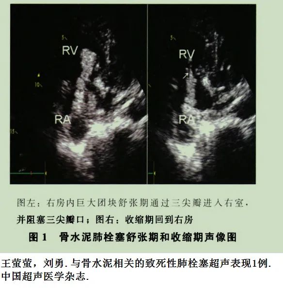 影像PPT - 【病例】骨水泥肺栓塞1例CT-5