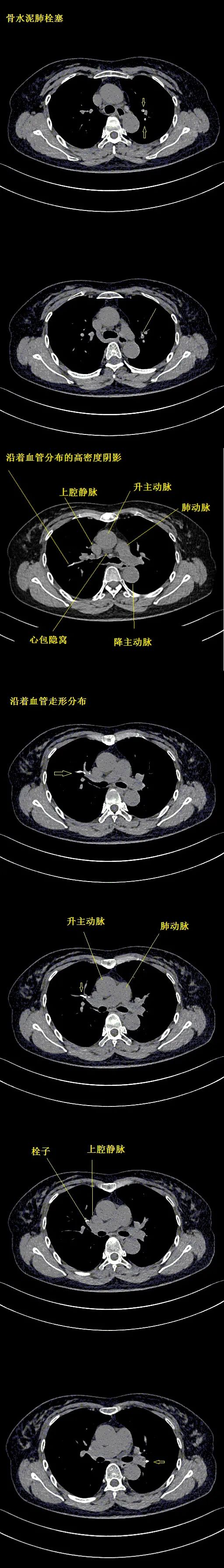 影像PPT - 【病例】骨水泥肺栓塞1例CT-2