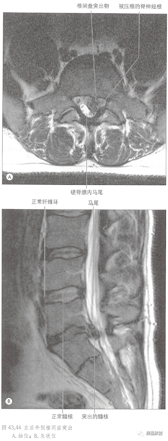 影像PPT - 脊柱(椎体、椎间盘、韧带)解剖-30 影像PPT - 脊柱(椎体、椎间盘、韧带)解剖-30
