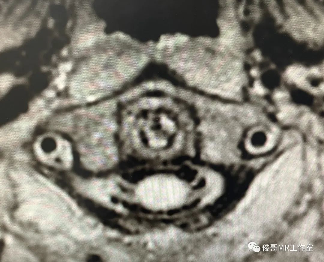 影像PPT - 用MRA做转颈试验诊断猎人弓综合征-8