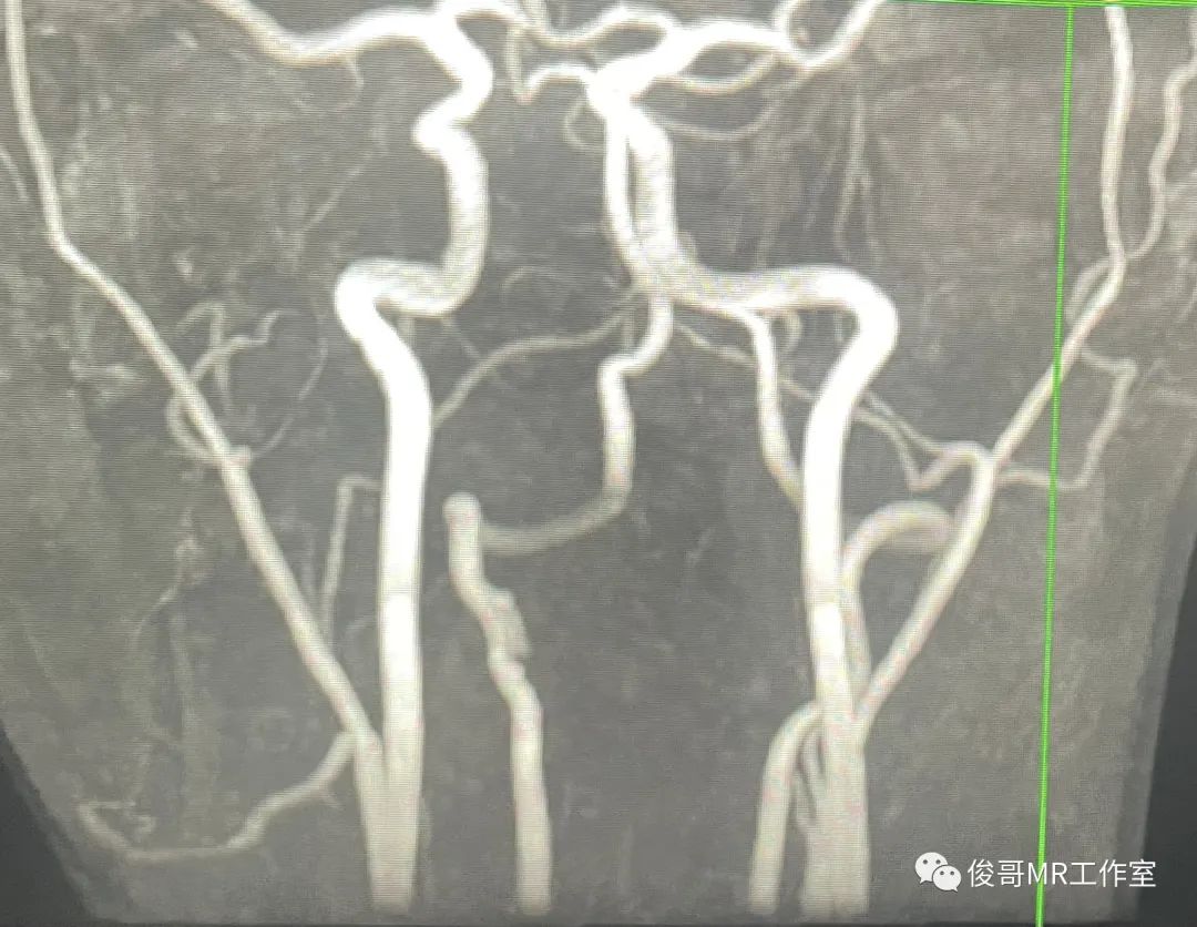影像PPT - 用MRA做转颈试验诊断猎人弓综合征-5