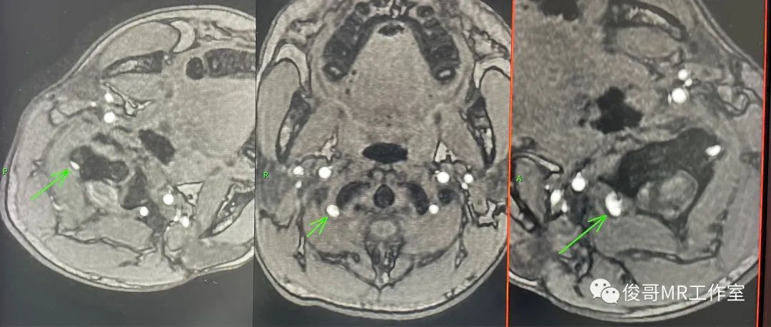 影像PPT - 用MRA做转颈试验诊断猎人弓综合征-11