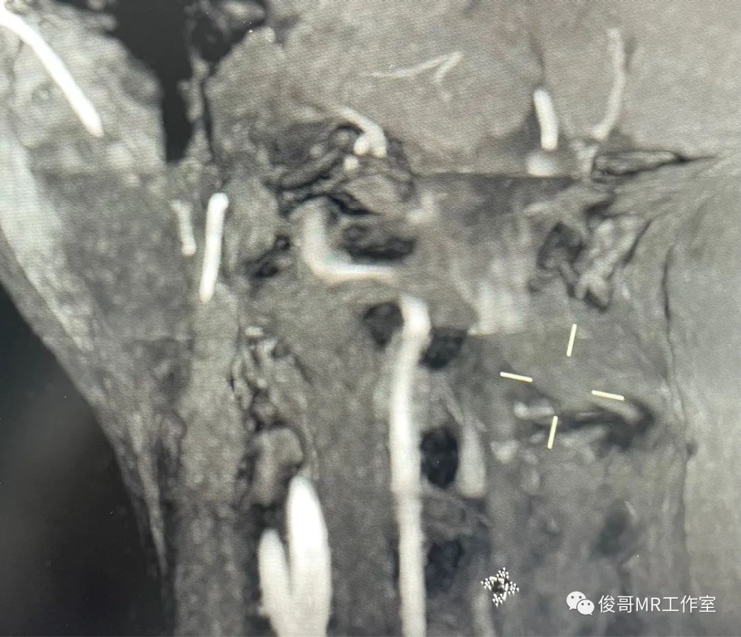 影像PPT - 用MRA做转颈试验诊断猎人弓综合征-12