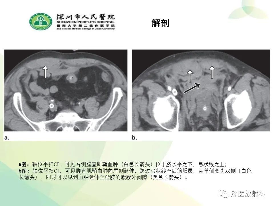 影像PPT - 【PPT】腹壁病变诊断思路-5