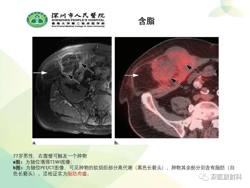 影像PPT - 【PPT】腹壁病变诊断思路-13