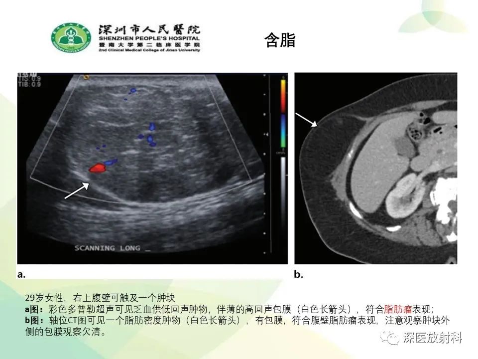 影像PPT - 【PPT】腹壁病变诊断思路-12