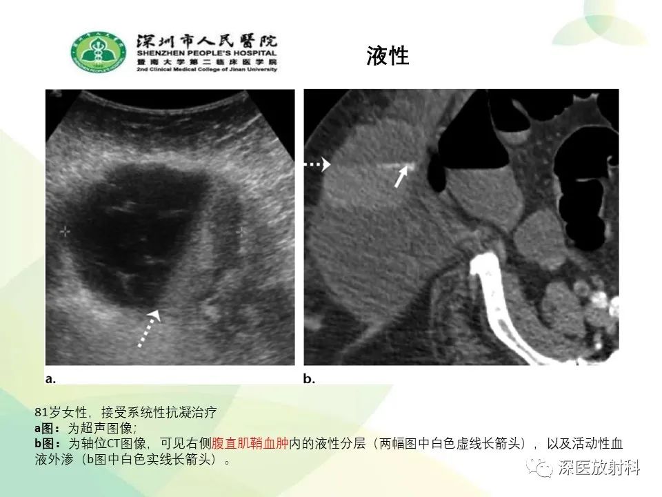 影像PPT - 【PPT】腹壁病变诊断思路-16