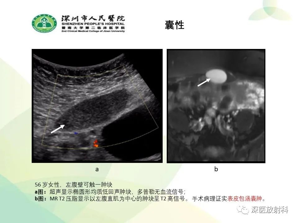 影像PPT - 【PPT】腹壁病变诊断思路-20