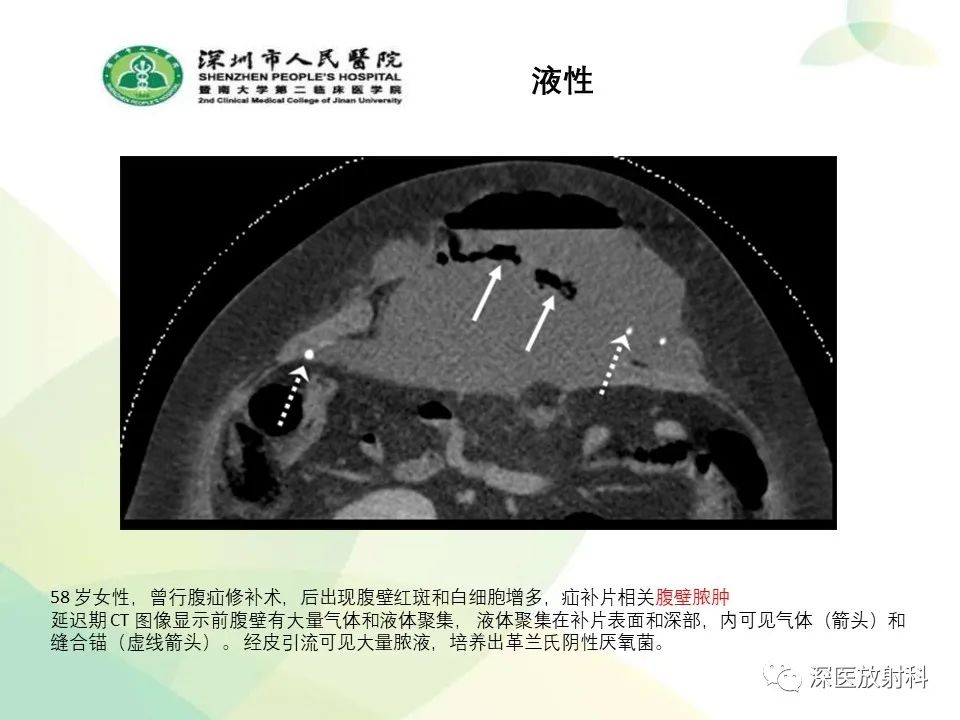 影像PPT - 【PPT】腹壁病变诊断思路-19