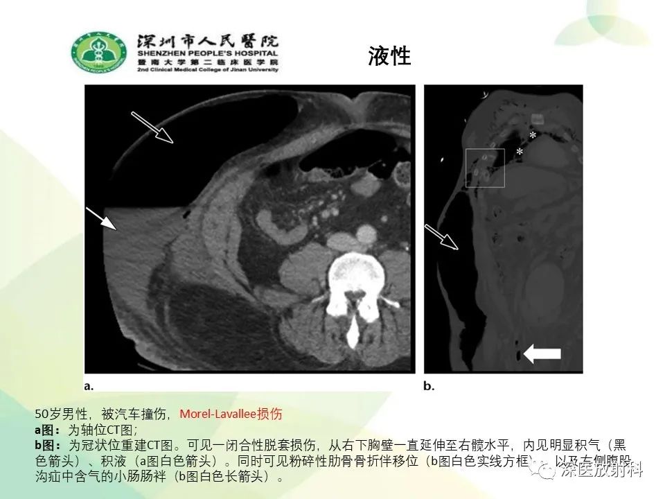 影像PPT - 【PPT】腹壁病变诊断思路-18