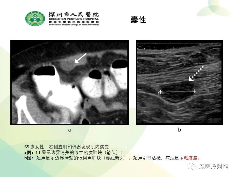 影像PPT - 【PPT】腹壁病变诊断思路-21
