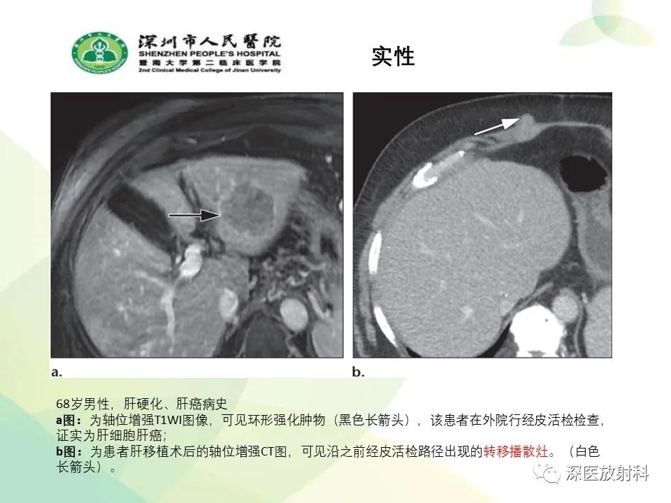 影像PPT - 【PPT】腹壁病变诊断思路-23