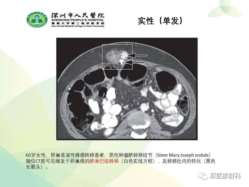 影像PPT - 【PPT】腹壁病变诊断思路-22
