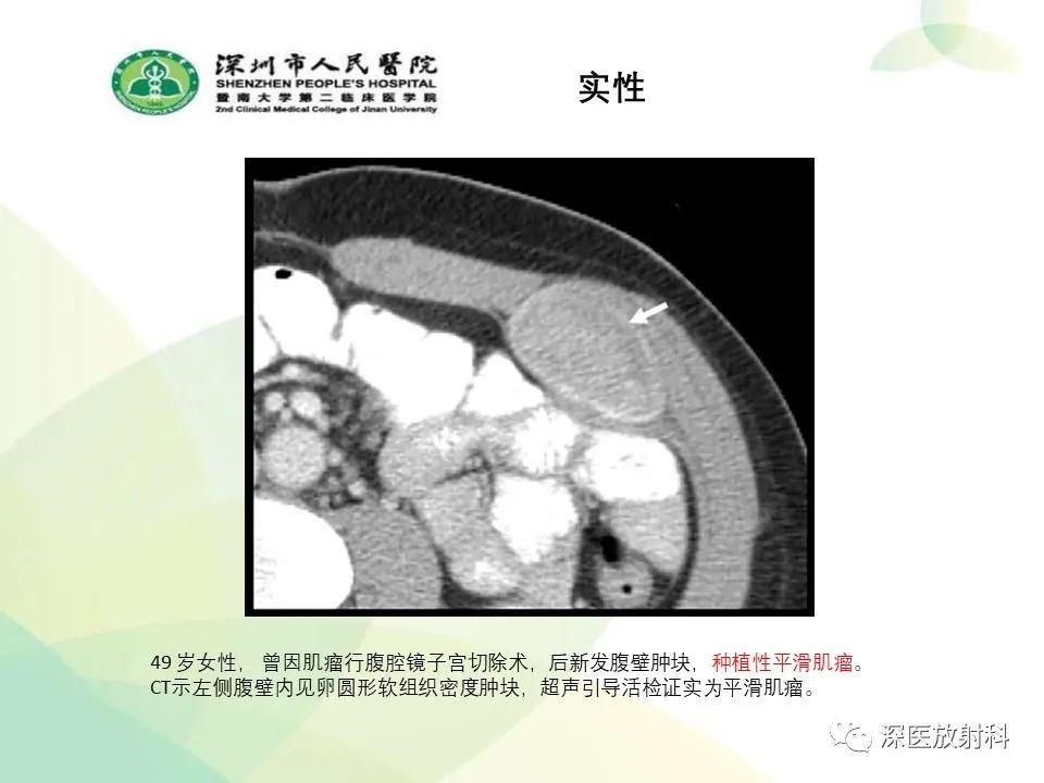 影像PPT - 【PPT】腹壁病变诊断思路-24
