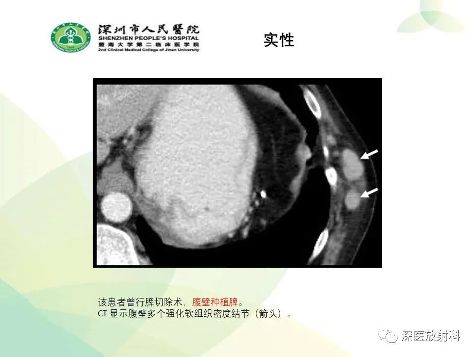 影像PPT - 【PPT】腹壁病变诊断思路-25