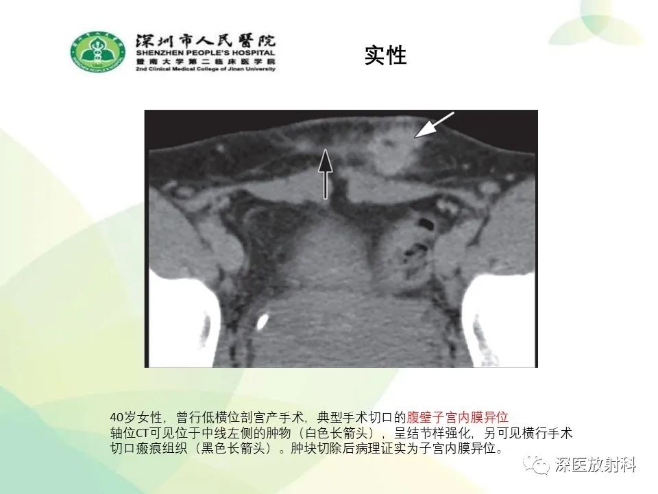 影像PPT - 【PPT】腹壁病变诊断思路-26