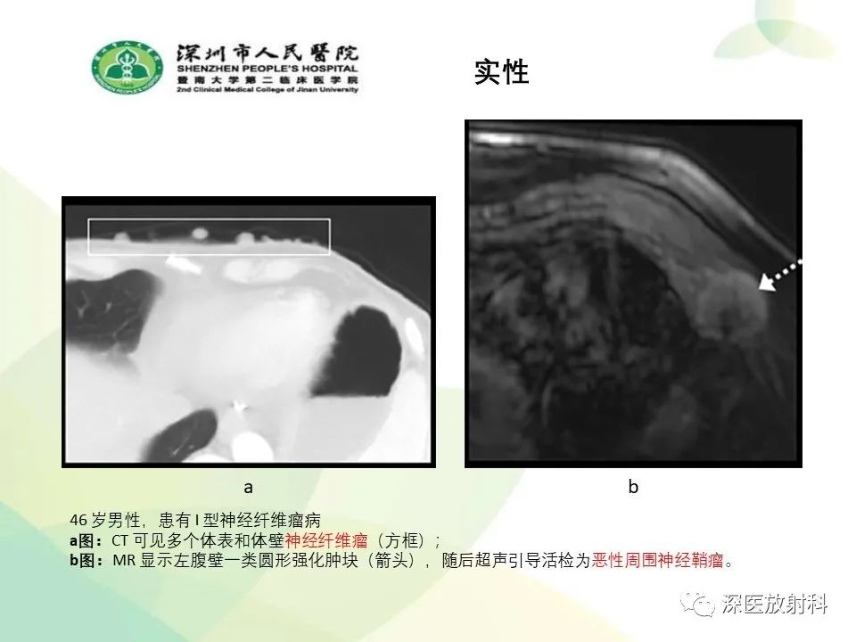 影像PPT - 【PPT】腹壁病变诊断思路-28